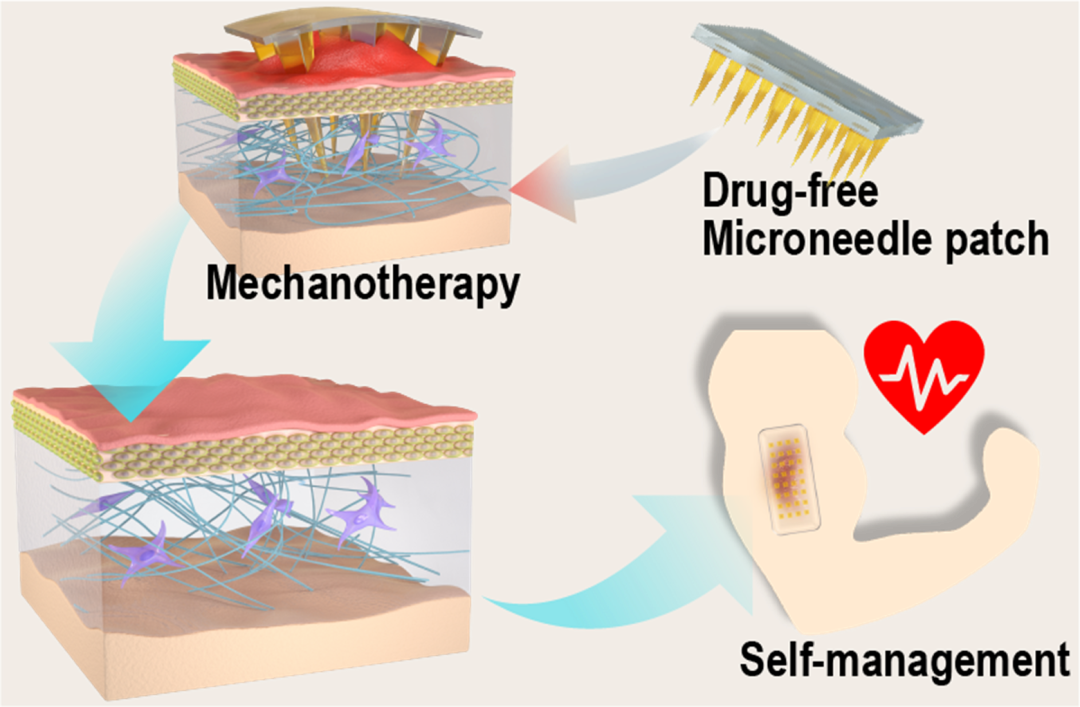 3D打印爱游戏官网入口度微针模具助力微针物理治疗增生性瘢痕的构效关系研究